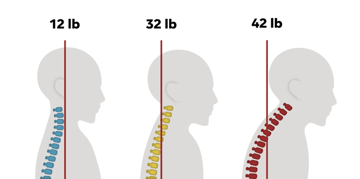 Tech Neck—What It Is and How to Treat It